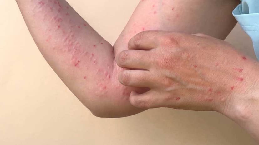 Sarampión: síntomas y prevención